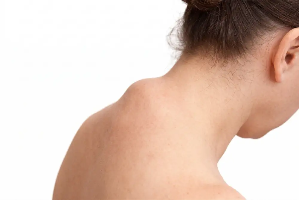 Remediu Cifoză Cervicală Brașov Tratament Gâlmă Ceafă